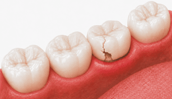 a failed crown or bridge wpd