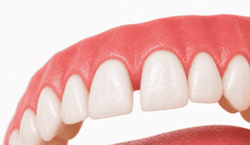 a front tooth gap wpd