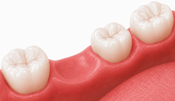 a single missing tooth wpd