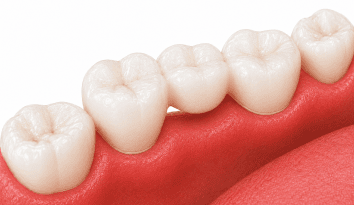 crowns and bridges wpd