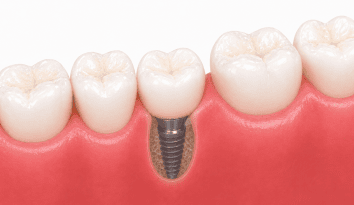 implant restorations wpd