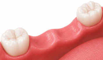 multiple missing teeth wpd