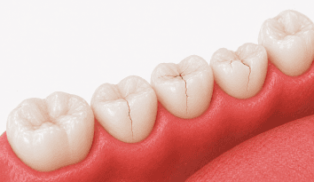 repeatedly cracked teeth wpd