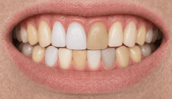 tooth colour wpd