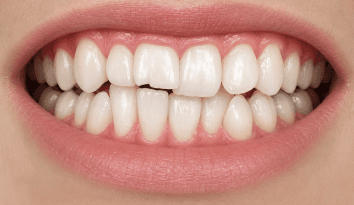 tooth shape wpd