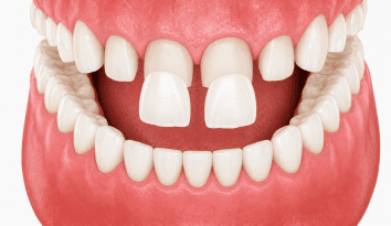 veneers and cosmetic dentistry wpd
