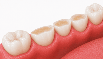worn teeth wpd