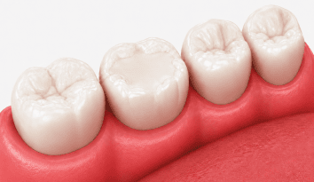 teeth after root canal wpd